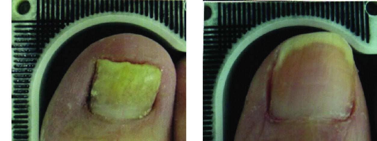 Before and After Laser Therapy For Toenail Fungus Patient 3