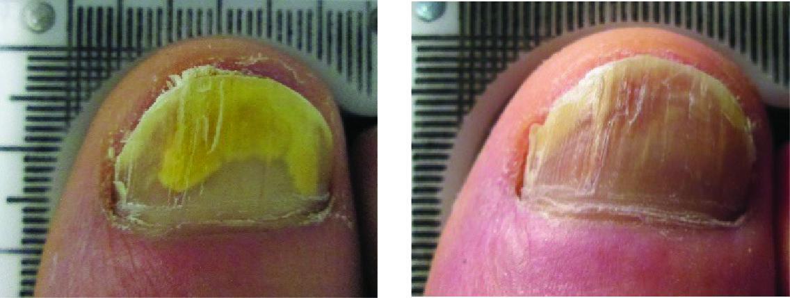 Before and After Laser Therapy For Toenail Fungus Patient 6