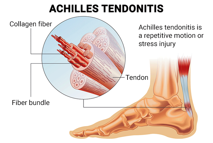 Achilles Tendonitis
