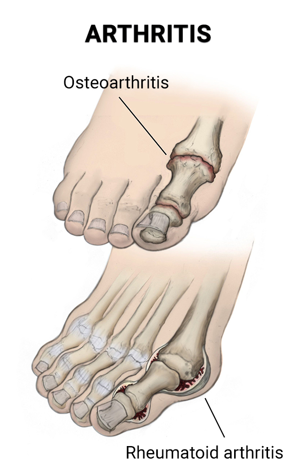 Arthritis