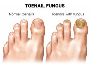 Why Is Toenail Fungus So Difficult to Treat Premier Podiatry