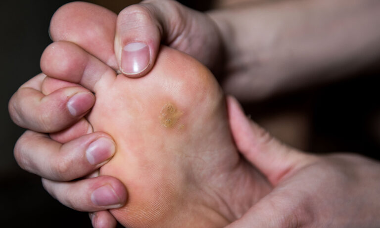 How to Safely Remove a Foot Corn at Home | Premier Podiatry