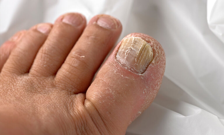 Why Is Toenail Fungus So Difficult to Treat | Premier Podiatry - Can I Paint My Toenails If I Have Fungus